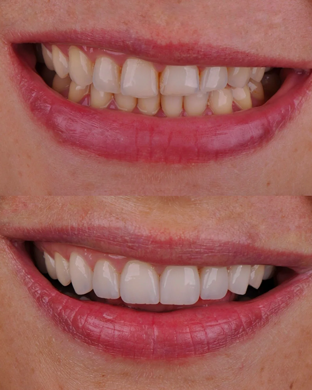 Antes e depois de um sorriso: dentes amarelados e desalinhados acima, claros e alinhados abaixo