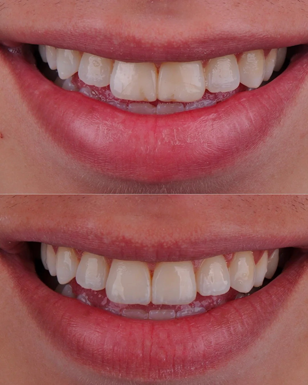 Antes e depois de um sorriso após tratamento estético
